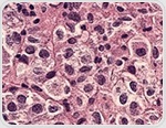 Cellular atlas offers clues to childhood Crohn’s treatment response