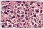 Subcutaneous tarlatamab exhibits low toxicity rates in phase 1b trial