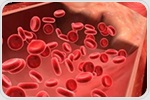 Catheter-directed thrombolysis improves short-term outcomes in pulmonary embolism patients
