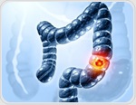 Why are more younger adults in the Eastern Mediterranean facing colorectal cancer?