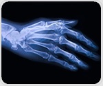 Scientists map key differences in stem cell potency for treating knee osteoarthritis