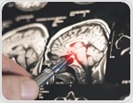 AI helps neurologists distinguish epilepsy from functional seizures