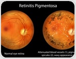 Gene therapy and special goggles help some blind adults detect objects again