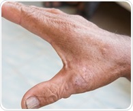 New imaging technique detects subtle skin changes in scleroderma patients