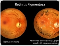 Gene therapy and special goggles help some blind adults detect objects again