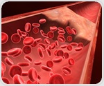 Study finds oral hormone replacement therapy increases venous thromboembolism risk