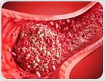 Coffee drinkers had fewer repeat blood clots in a Norwegian study