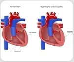 Genetic Mutation Associated with Hypertrophic Cardiomyopathy