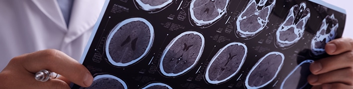 Multiple Sclerosis tile image