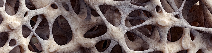 Osteoporosis tile image