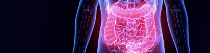 Diverticulitis tile image
